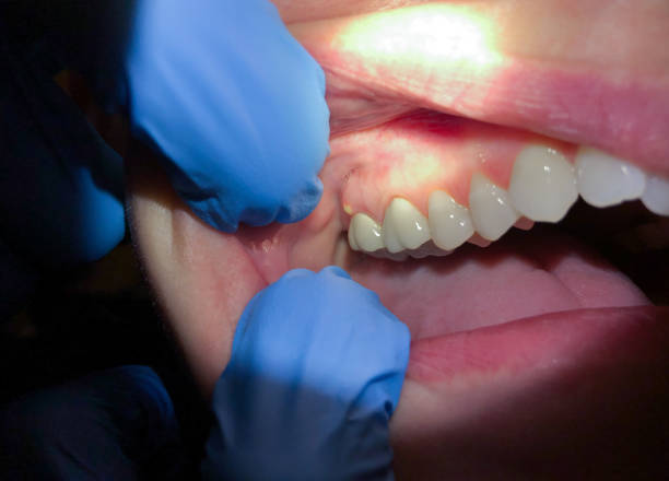 Best Emergency Treatment for Dental Infections or Abscesses in Fort Davis, TX