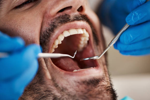 Best Emergency Dental Care for Broken or Chipped Teeth in Fort Davis, TX