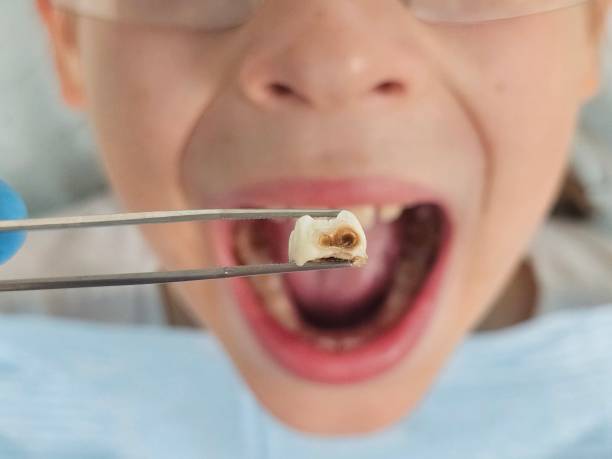 Best Emergency Tooth Extraction in Fort Davis, TX